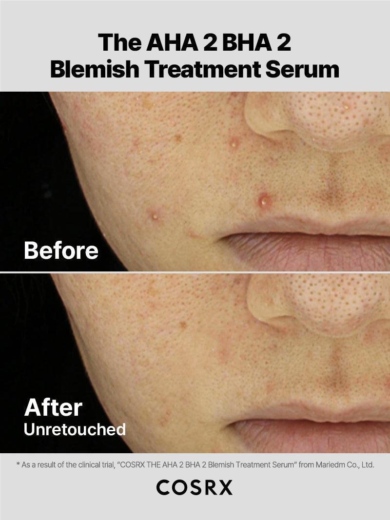 The AHA 2 BHA 2 Blemish Tratamiento Sérum — COSRX