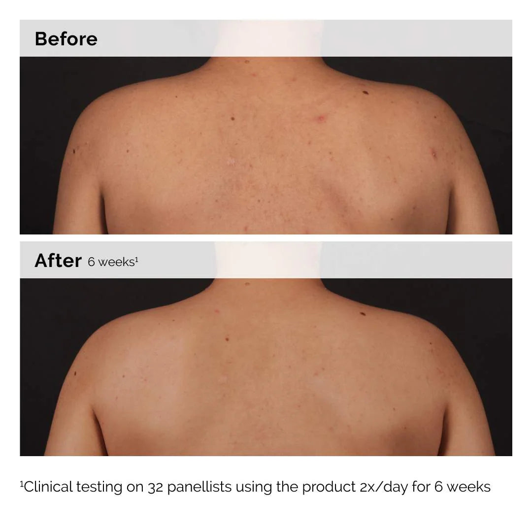 Tratamiento exfoliante de suero corporal con ácido salicílico al 0,5% para el acné — The Ordinary