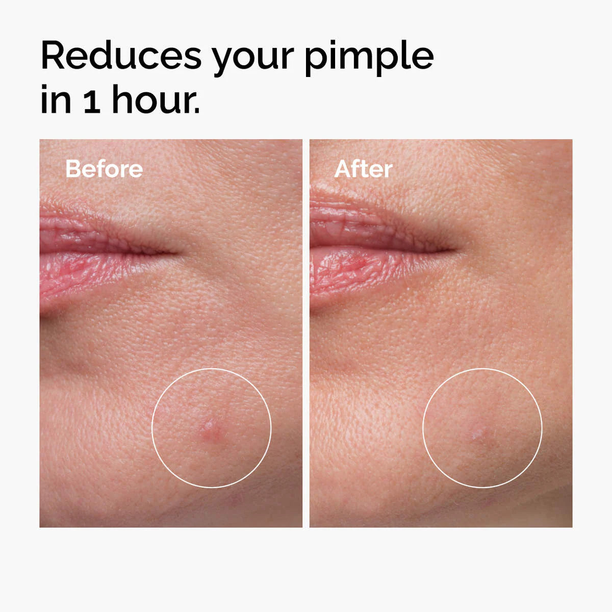Tratamiento concentrado de azufre en polvo a crema para las manchas del acné al 10% — The Ordinary