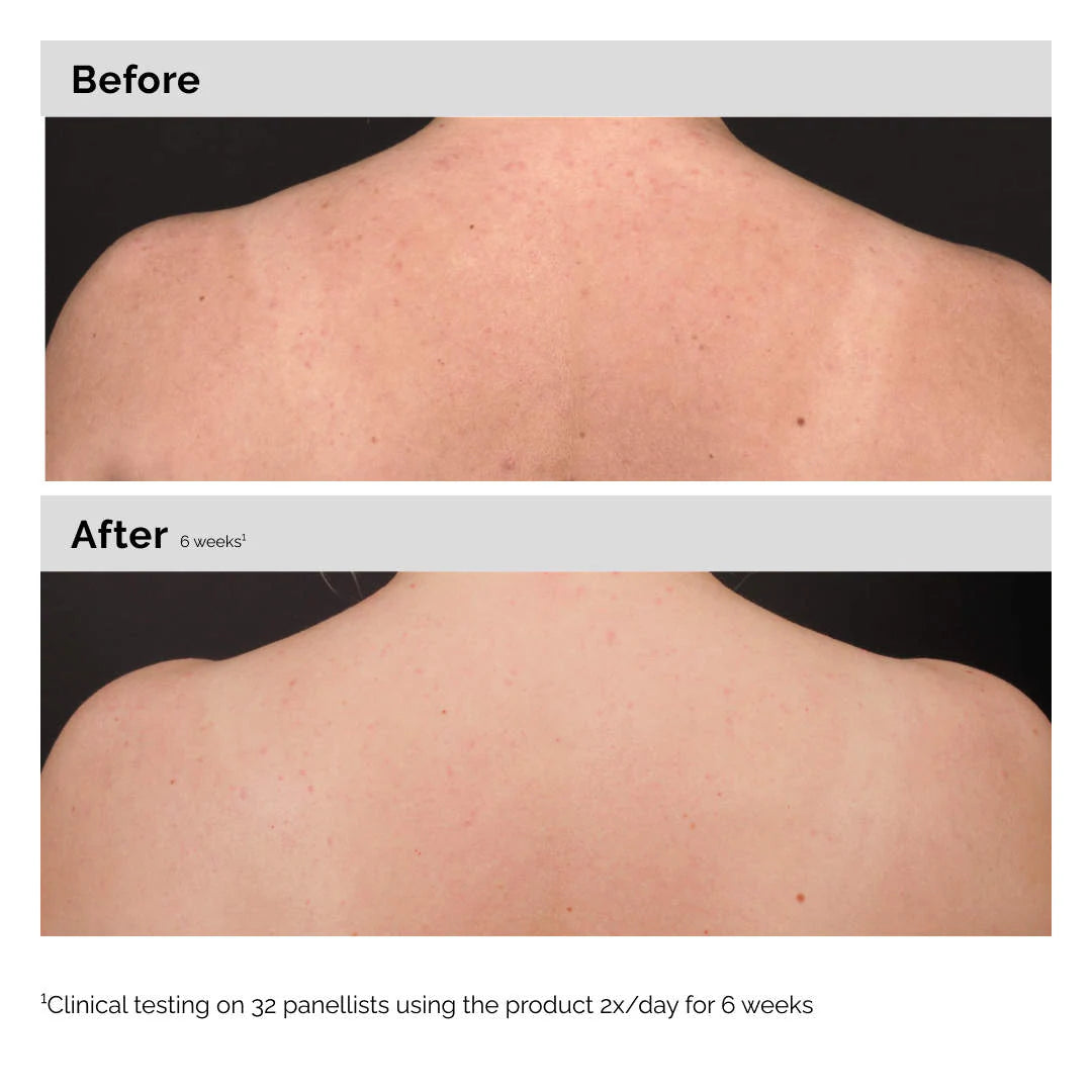 Tratamiento exfoliante de suero corporal con ácido salicílico al 0,5% para el acné — The Ordinary